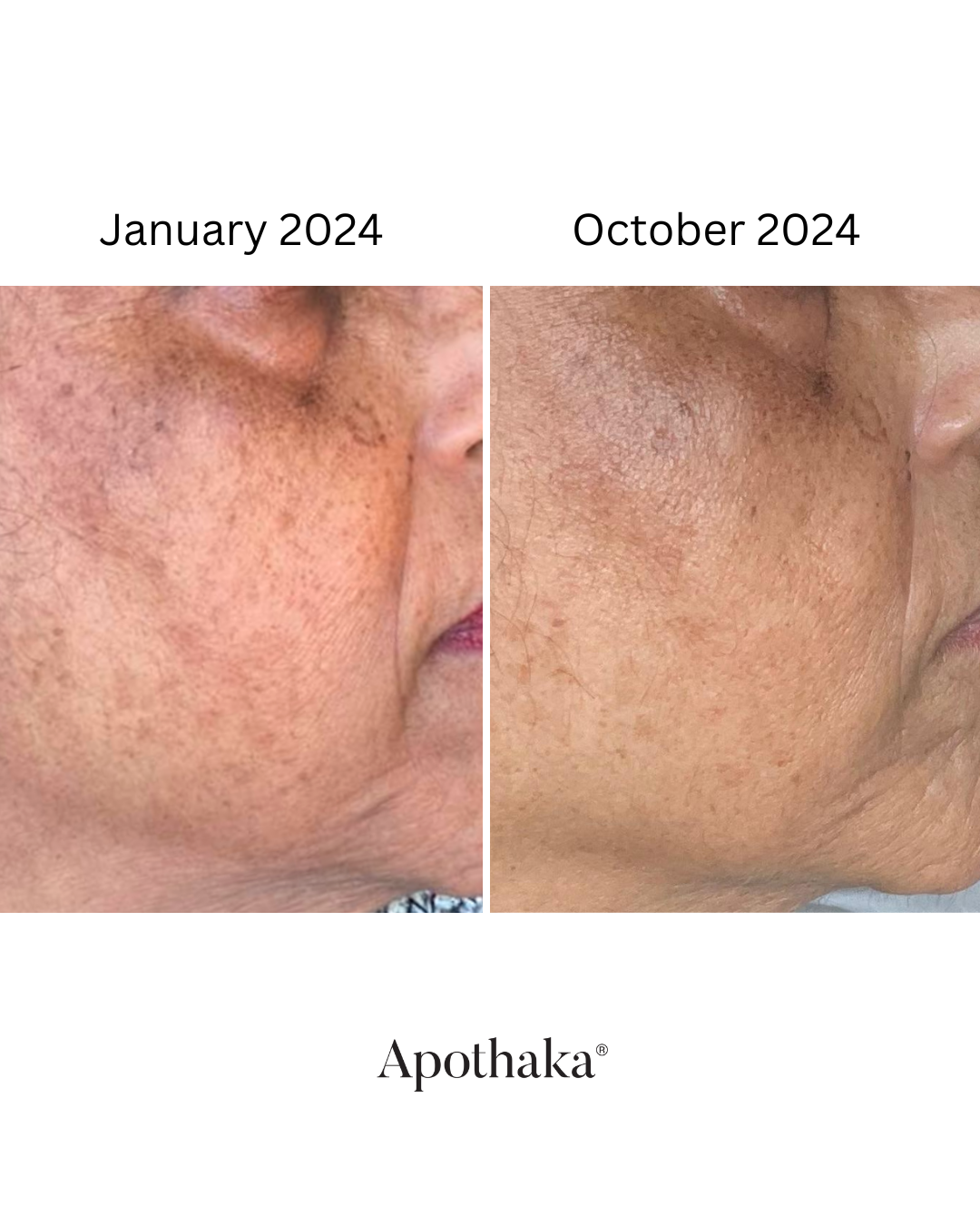 Real skin, real results with barrier renew retinal serum showing a more even tone and smoother skin after 10 months of use