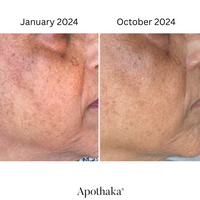 Real skin, real results with barrier renew retinal serum showing a more even tone and smoother skin after 10 months of use